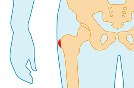 Schleimbeutelentzündung Hüfte: Bursitis trochanterica / iliopectinea